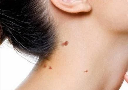 Innovative Techniques for Warts Skin Plastic Surgery Treatment